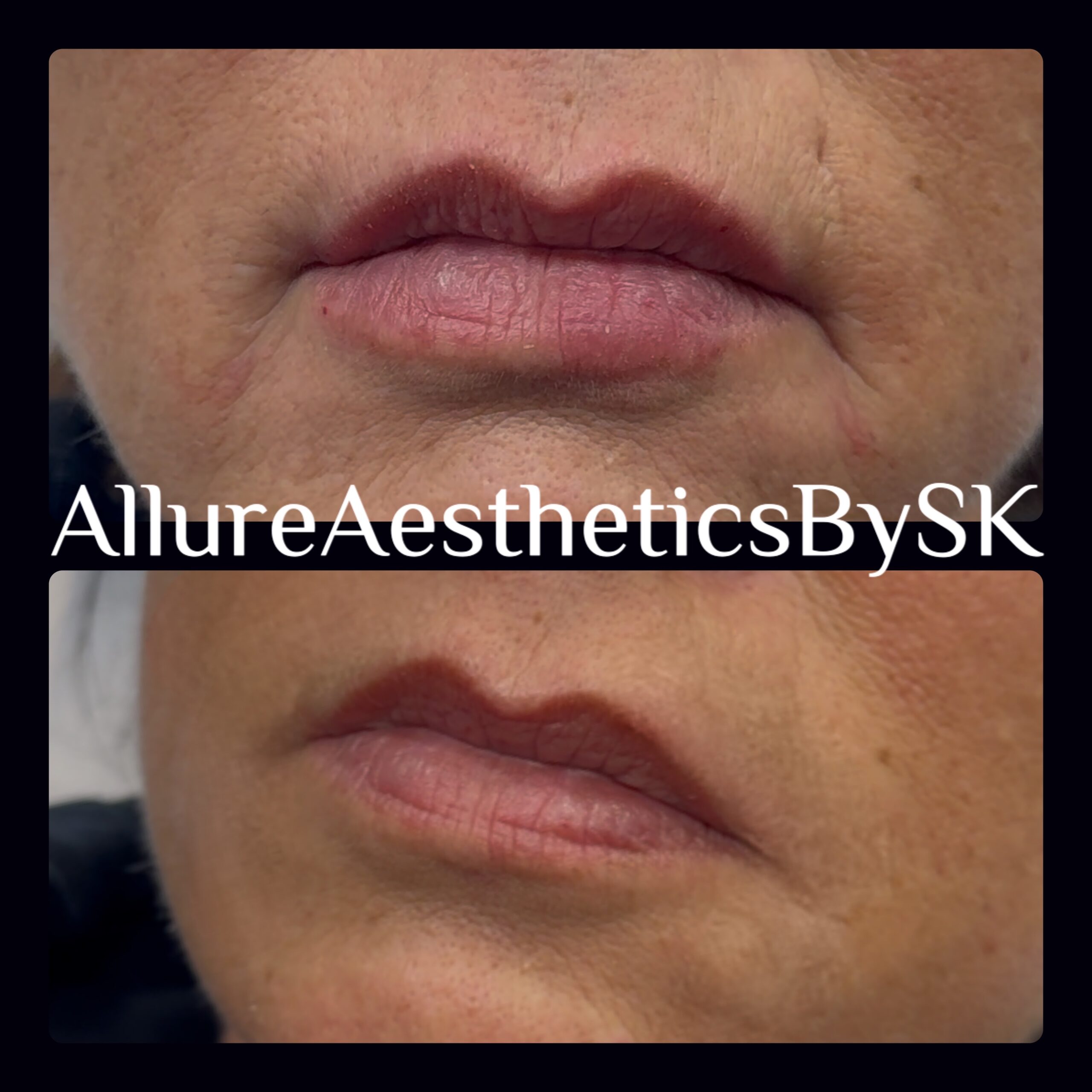 Dermal filler website page pic